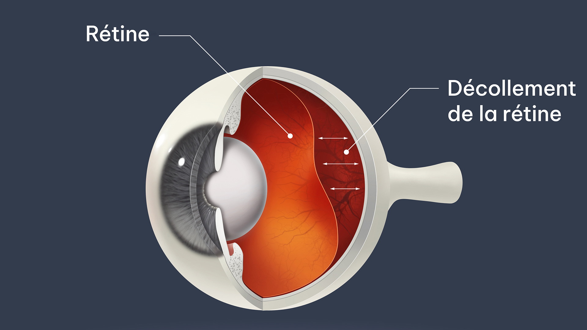 Décollement de la rétine